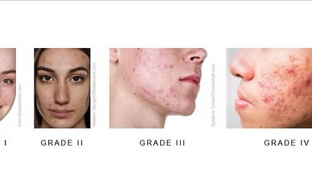 Acne grade chart showing Grade I through Grade IV severity levels for professional acne treatment in Atlanta