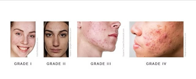 Acne grade chart showing Grade I through Grade IV severity levels for professional acne treatment in Atlanta