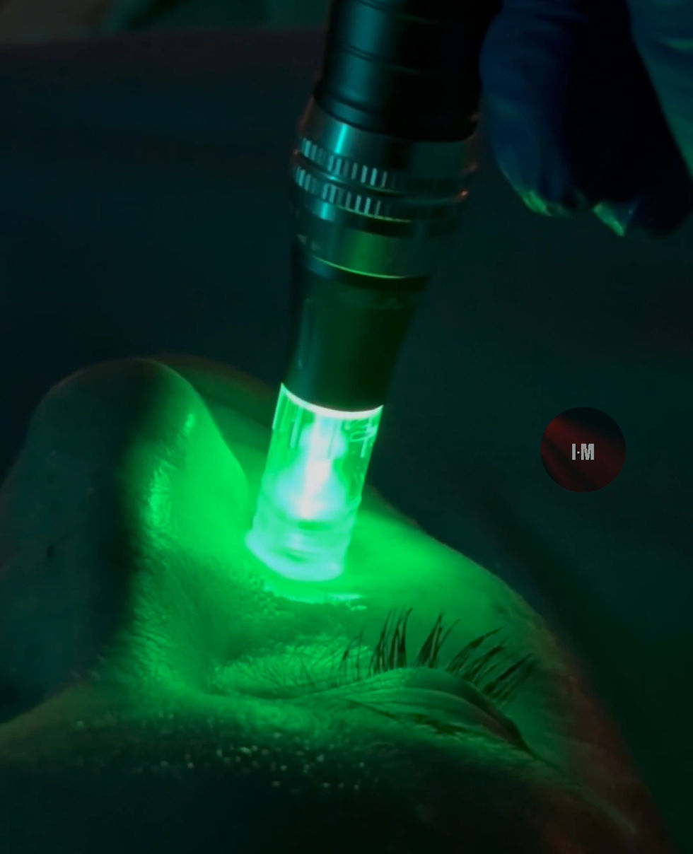 Infrared Needle Pen Professional Microneedling Device