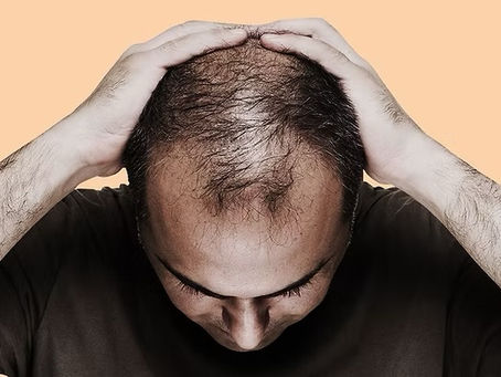 Microneedling treatment for male hair loss in Atlanta