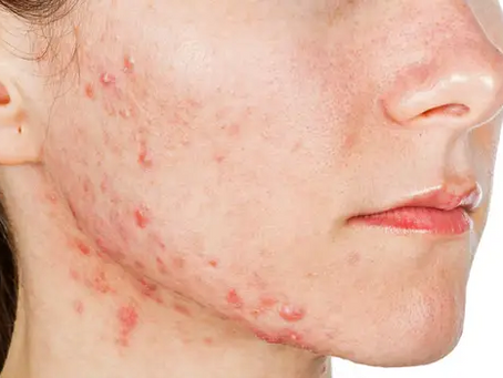 Woman with PCOS-related hormonal acne, acne scarring, and post-inflammatory hyperpigmentation on the cheek before professional acne treatment in Atlanta.