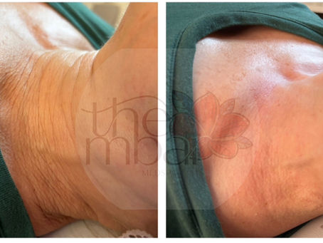 Before and after results of HIFU skin tightening treatment in Atlanta