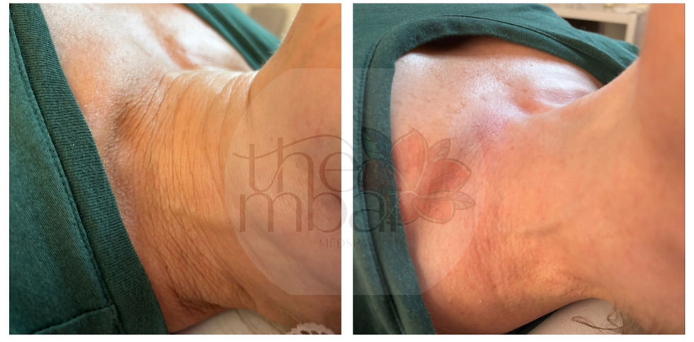Before and after results of HIFU skin tightening treatment in Atlanta