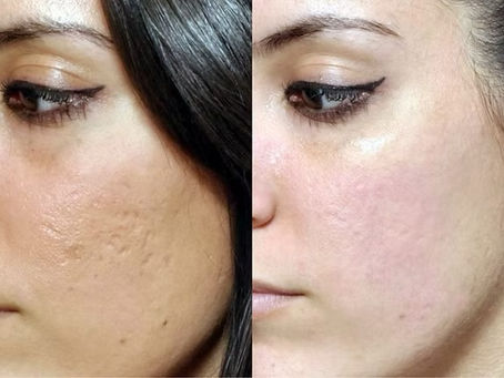 Before and after microneedling treatment for acne scars and skin texture improvement in Atlanta