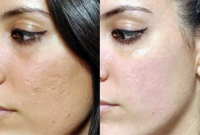 Before and after microneedling treatment for acne scars and skin texture improvement in Atlanta