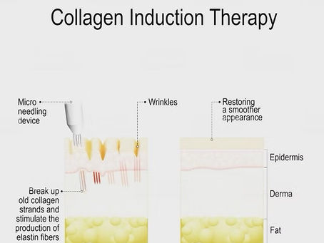 Microneedling collagen induction therapy diagram used at Atlanta medspa