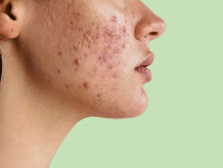 Active acne on cheek before laser treatment in Atlanta