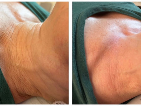 HIFU Skin Tightening in Atlanta: Non-Surgical Facelift Without Downtime