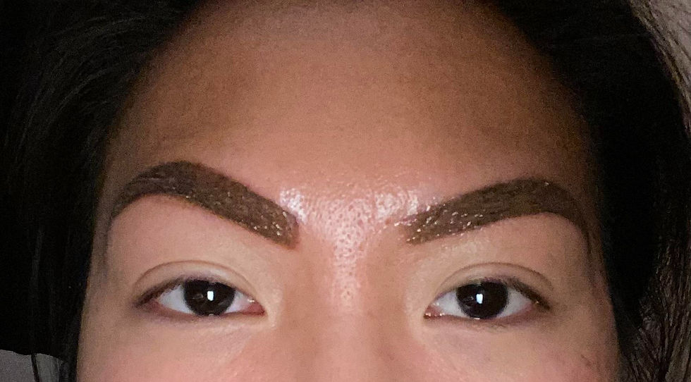 Before and after laser treatment fading botched microblading pigment during eyebrow tattoo removal in Atlanta.