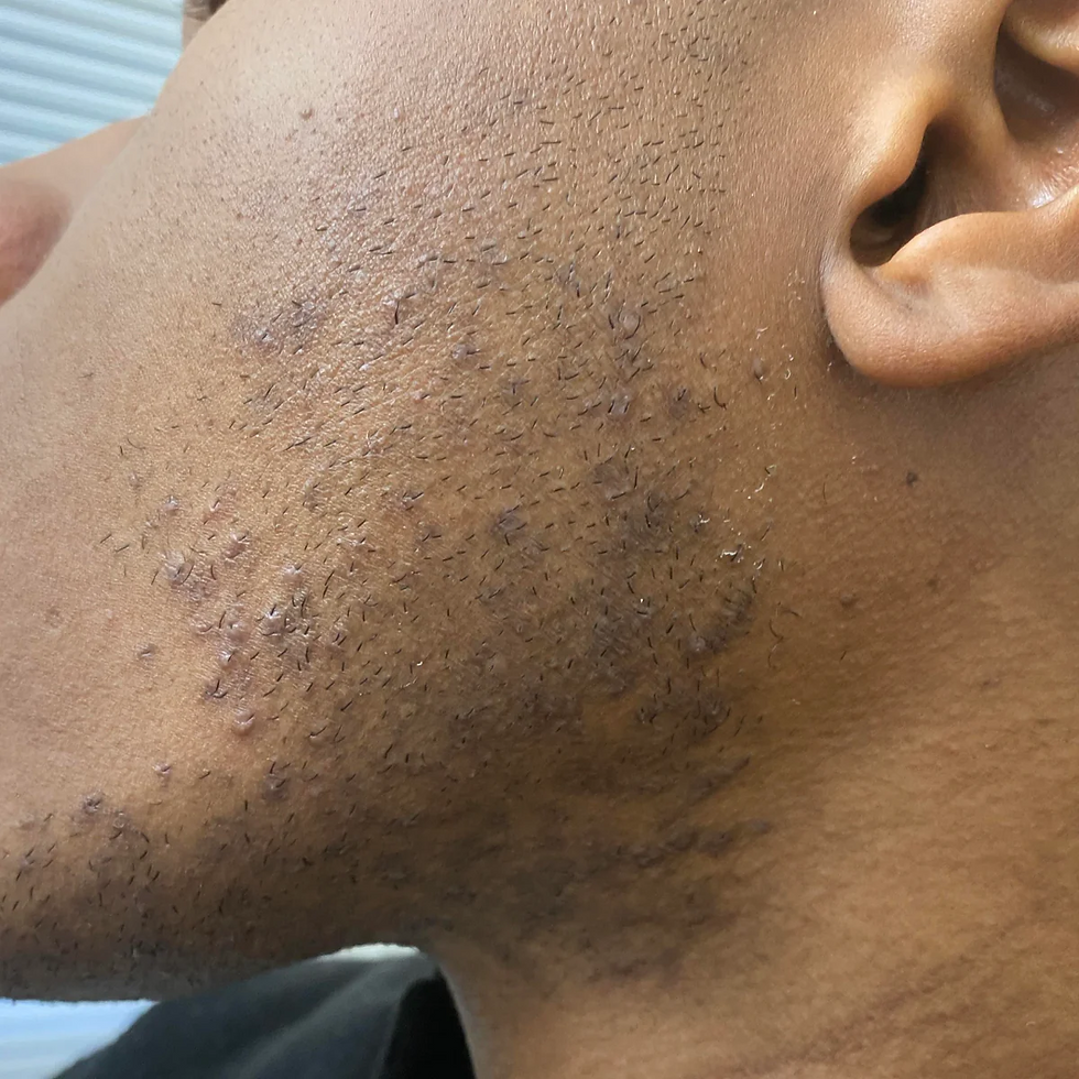 Man receiving microneedling treatment for beard hyperpigmentation and dark spots in Atlanta