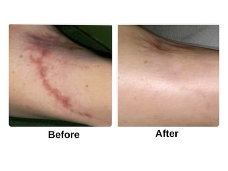 Raised surgical scar before microneedling treatment in Atlanta.