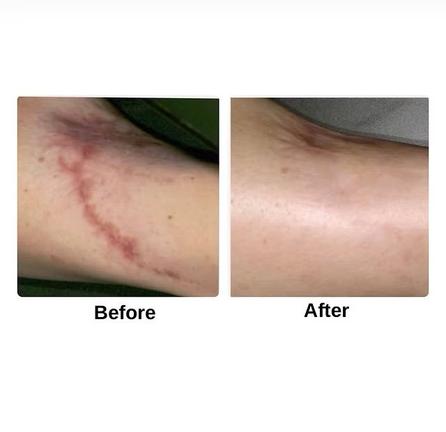 Raised surgical scar before and after microneedling treatment in Atlanta.