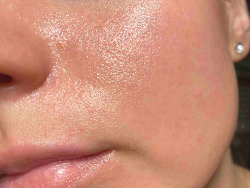 Client with enlarged facial pores before professional microneedling treatment to improve skin texture at The Mbar Medspa in Atlanta.