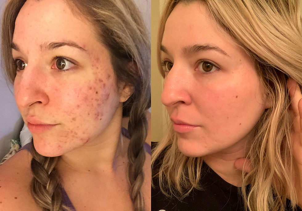 Woman with hormonal acne, jawline breakouts, and post-inflammatory hyperpigmentation before acne treatment at The Mbar Medspa in Atlanta.