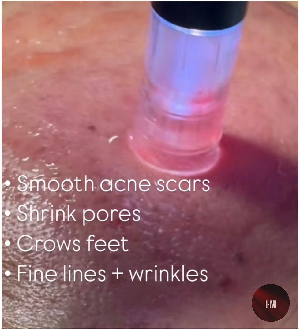 Infrared microneedling treatment used to improve acne scars and stimulate collagen