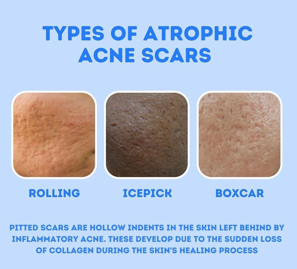Different types of acne scars