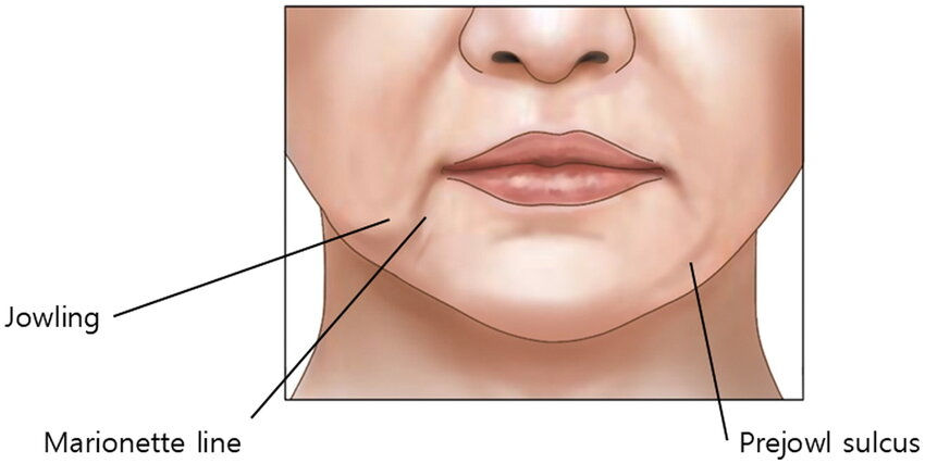 Illustration showing common HIFU treatment areas including the jawline, jowls, marionette lines, and lower face tightening