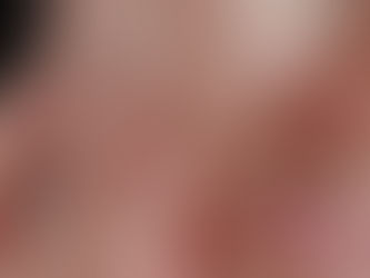 Close-up of enlarged facial pores on cheek before microneedling treatment for pore reduction in Atlanta.