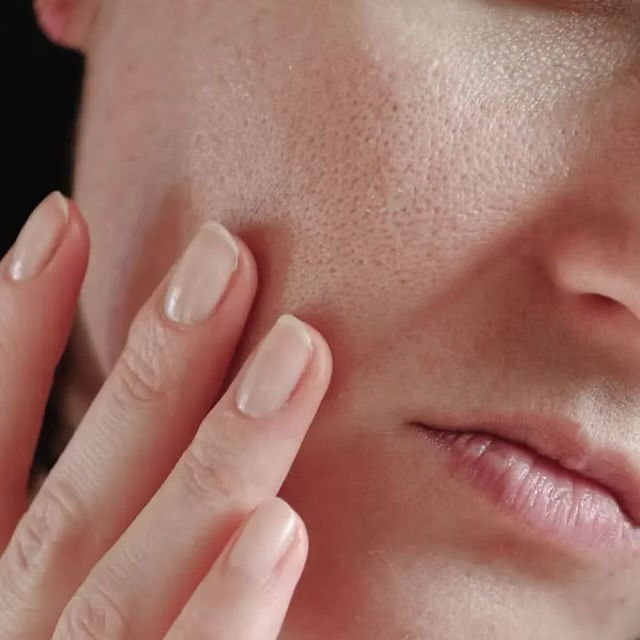 Close-up of enlarged facial pores on cheek before microneedling treatment for pore reduction in Atlanta.