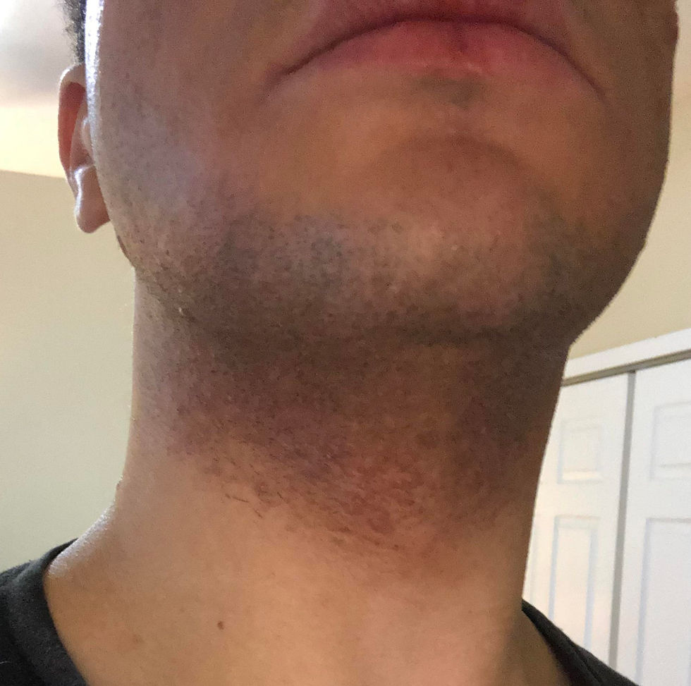 Man with razor bumps and beard hyperpigmentation along the jawline and neck area