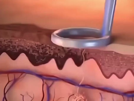 How Laser Treatments Work in Atlanta: Acne, Hyperpigmentation & Tattoo Removal Explained