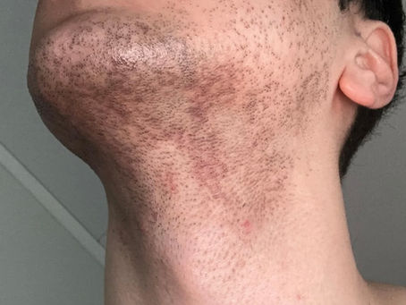 Man with beard hyperpigmentation and dark spots along the jawline