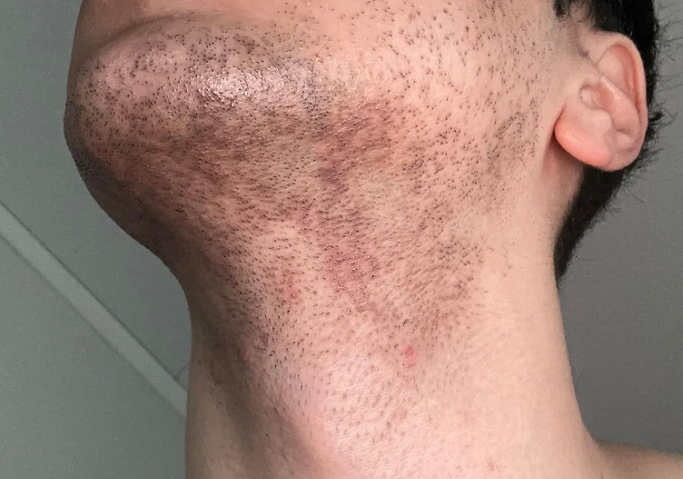 Man with beard hyperpigmentation and dark spots along the jawline