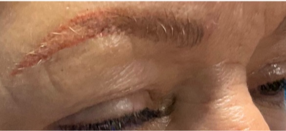 Laser microblading removal treatment fading unwanted eyebrow tattoo pigment during brow correction in Atlanta.