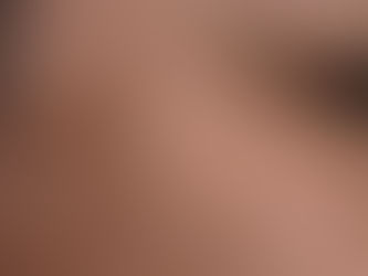 Close-up of sun spots and hyperpigmentation treated with Laser Genesis in Atlanta