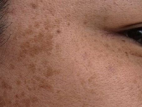 Close-up of sun spots and hyperpigmentation treated with Laser Genesis in Atlanta