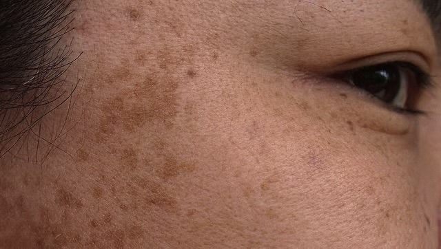 Close-up of sun spots and hyperpigmentation treated with Laser Genesis in Atlanta
