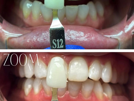Zoom teeth whitening results showing brighter smile after professional in-office whitening treatment.