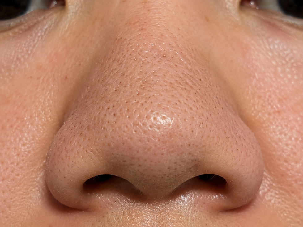 Close-up of enlarged pores on the nose before professional microneedling treatment at The Mbar Medspa in Atlanta.
