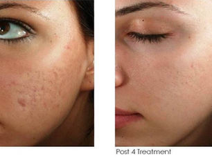 microneedling before and after results showing improved skin texture and reduced acne scars
