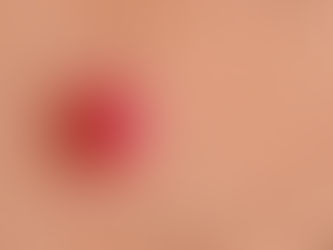Close-up of a raised red cherry angioma on skin before professional removal