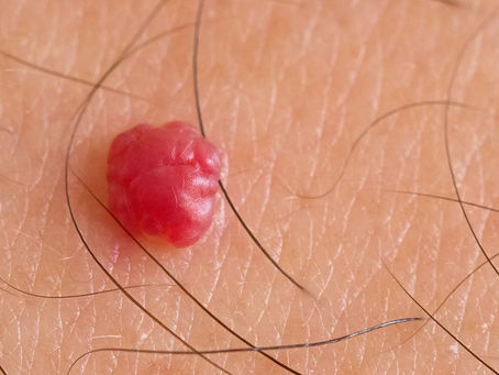 Close-up of a raised red cherry angioma on skin before professional removal