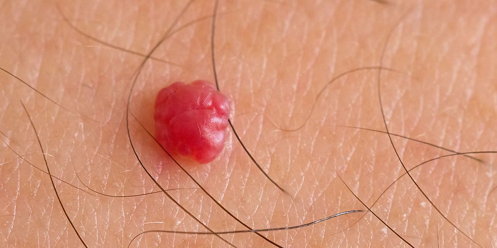 Close-up of a raised red cherry angioma on skin before professional removal