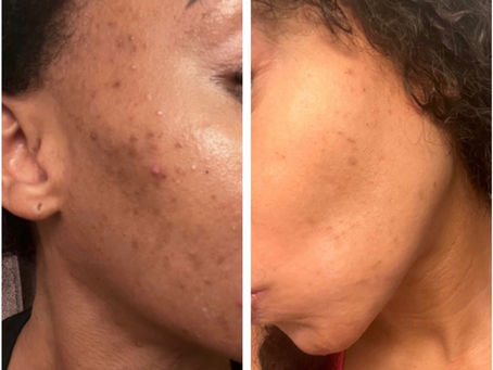 Laser facial treatment for acne dark spots and hyperpigmentation on the face