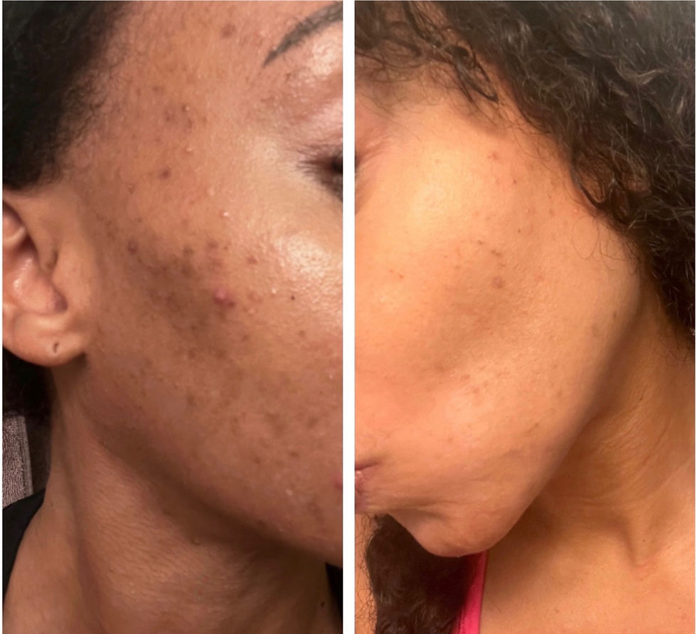 Laser facial treatment for acne dark spots and hyperpigmentation on the face