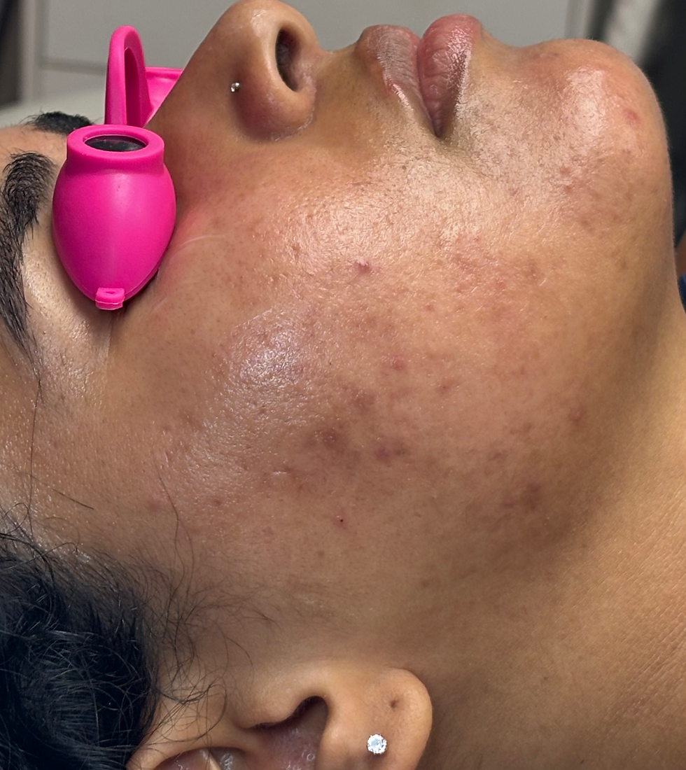 Best facial for acne-prone skin treatment at The Mbar Medspa in Atlanta
