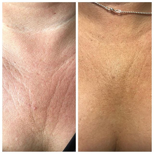 Microneedling in Atlanta before and after results for acne scars