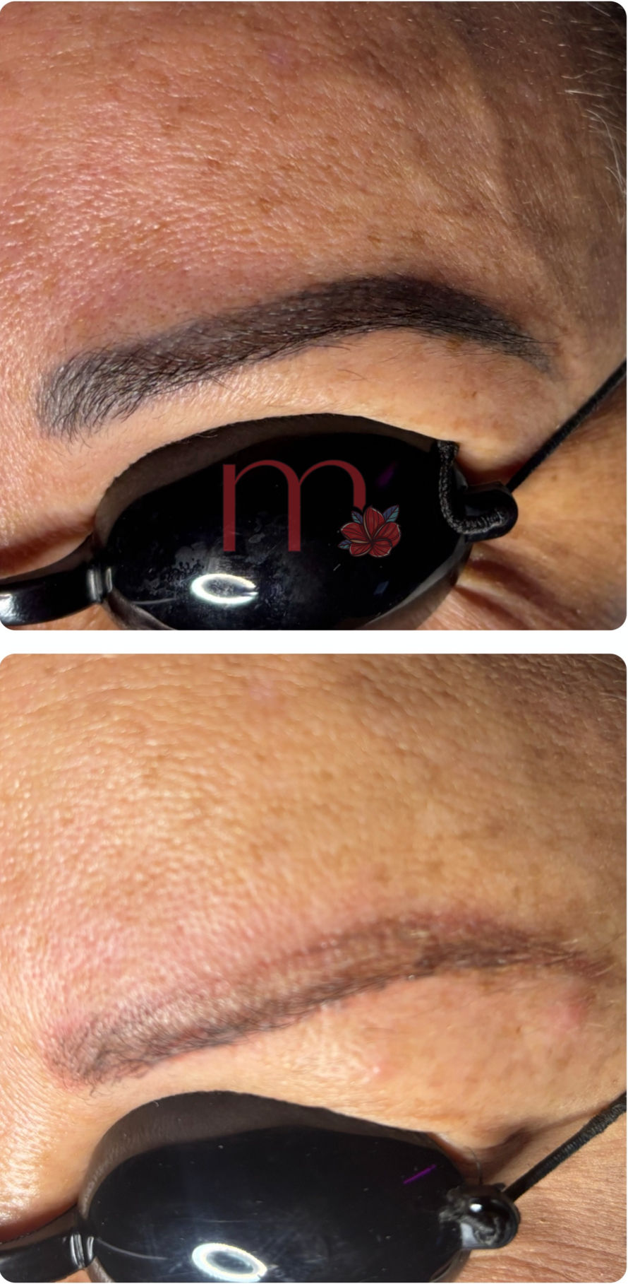 Eye Brow Removal Atlanta