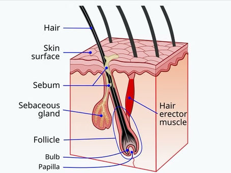 Diagram of hair follicle and sebaceous gland showing how sebum production contributes to acne formation