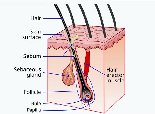 Diagram of hair follicle and sebaceous gland showing how sebum production contributes to acne formation