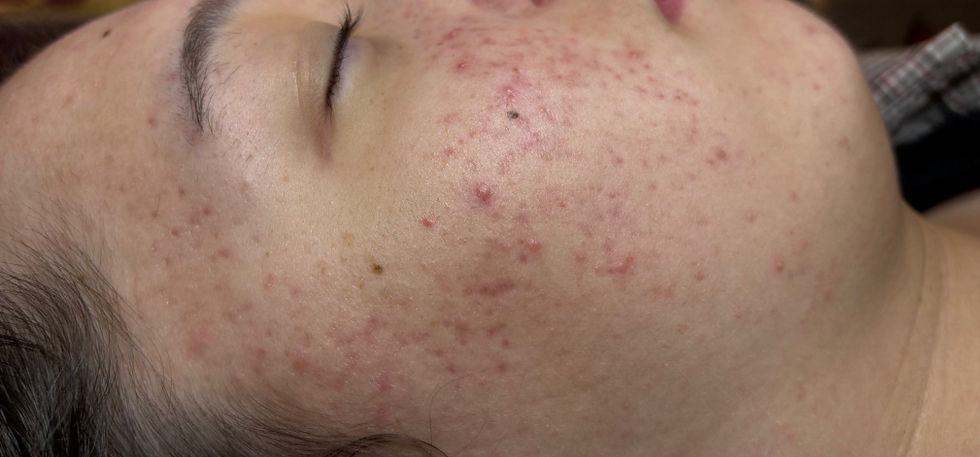 Esthetician performing a laser facial treatment for hormonal acne in Atlanta