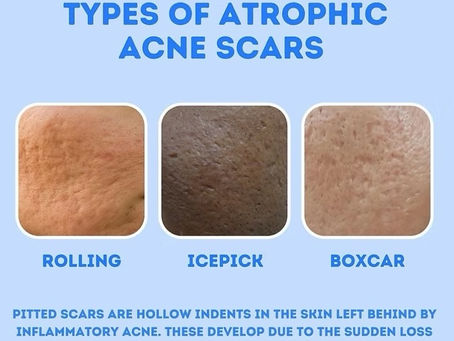 Types of acne scars treated with microneedling in Atlanta