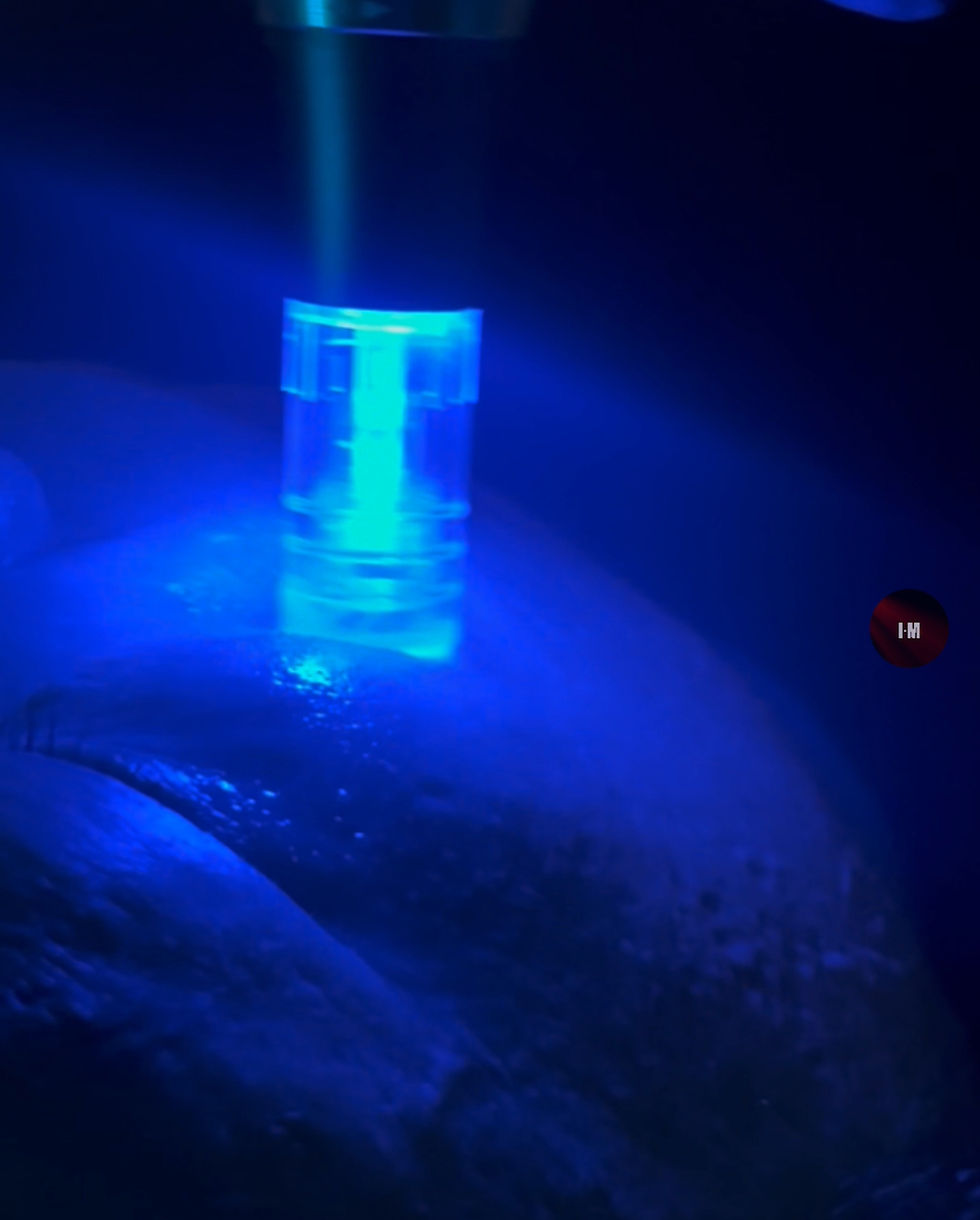 blue light therapy targeting acne bacteria during microneedling