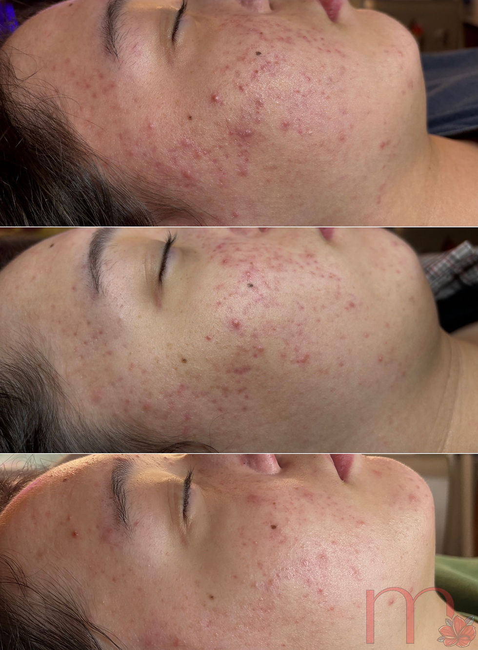 Laser treatment results for hormonal acne in Atlanta