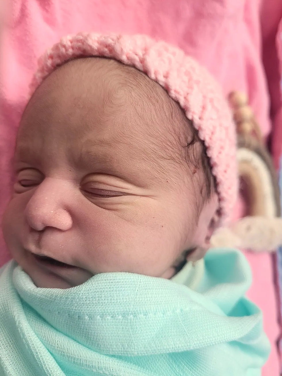 Newborn girl with Caudal Regression Syndrome