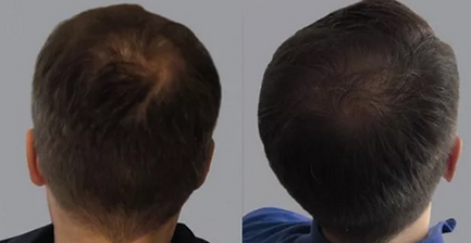 Hair Filler Dr CYJ Manchester